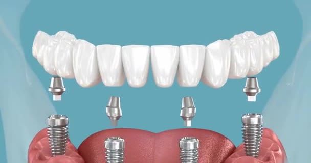 All-on-4 Patientengeschichte bei SDS Dental