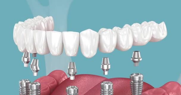 All-on-6 Patientengeschichte bei SDS Dental