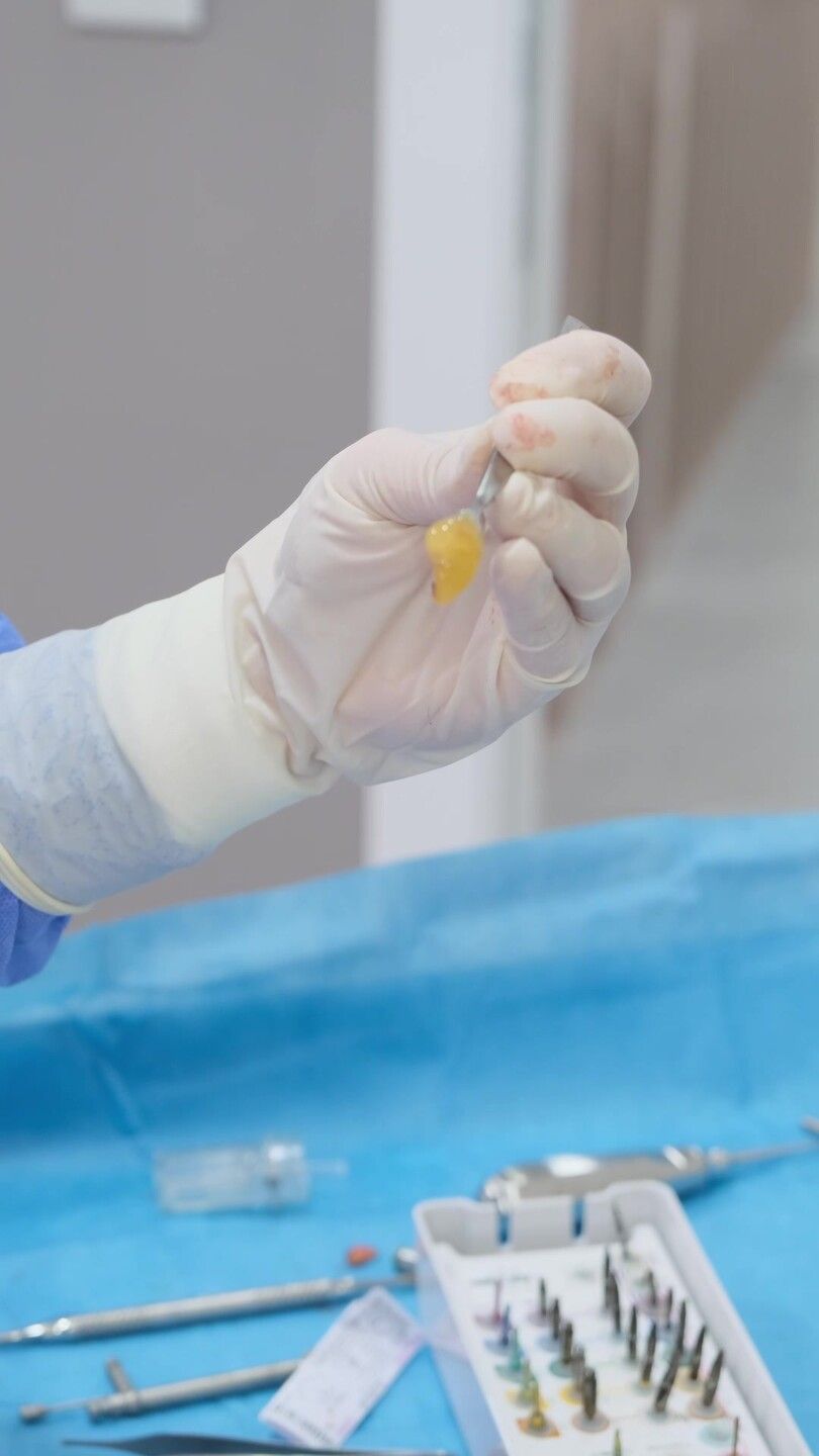 PRF-Behandlung bei SDS Dental