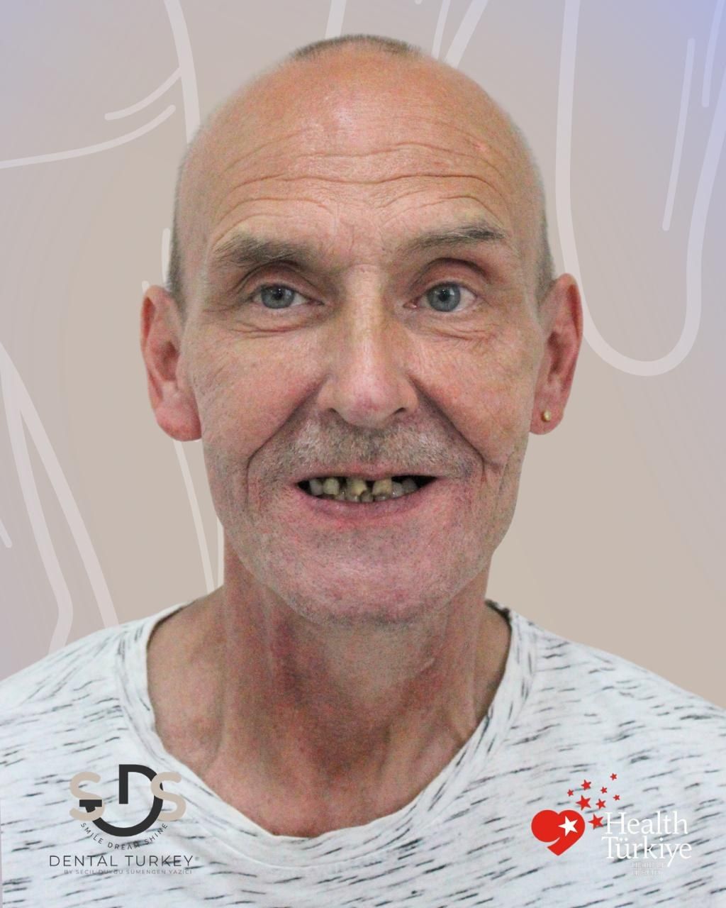 Before treatment, face view