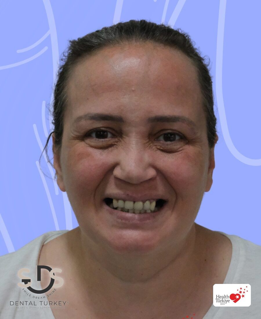 Before treatment, face view
