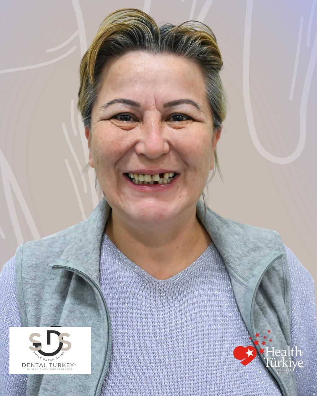 Before treatment, face view