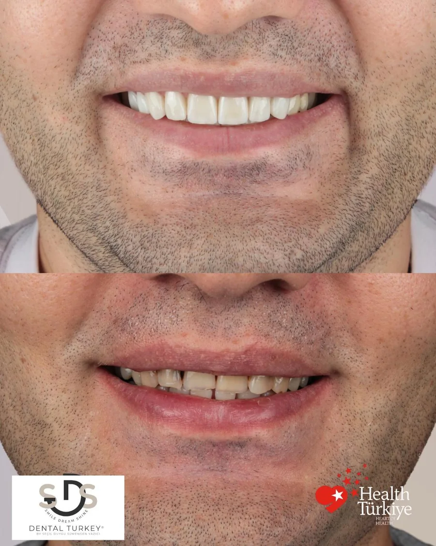 Before and after E-max veneers on the front teeth