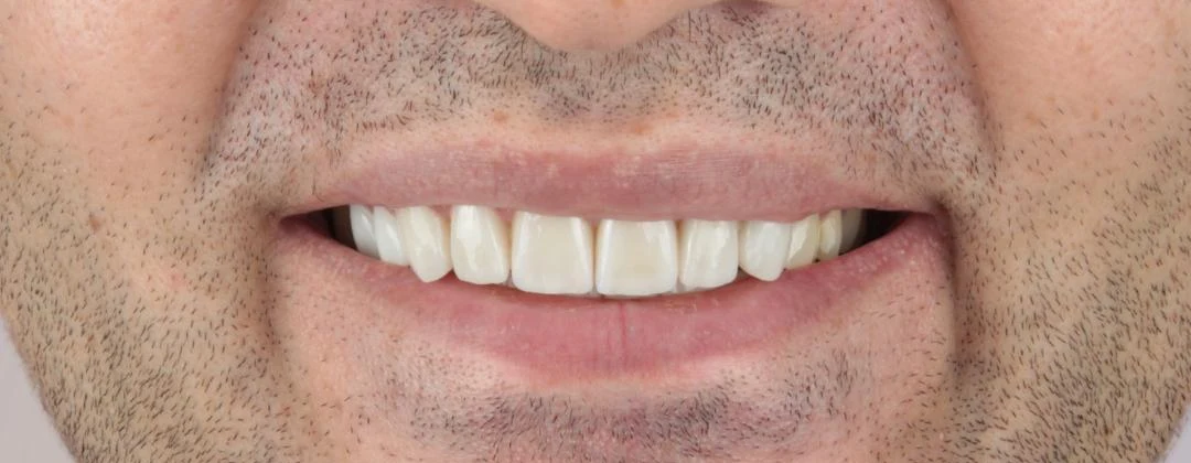Front teeth after E-max veneers, close-up smile