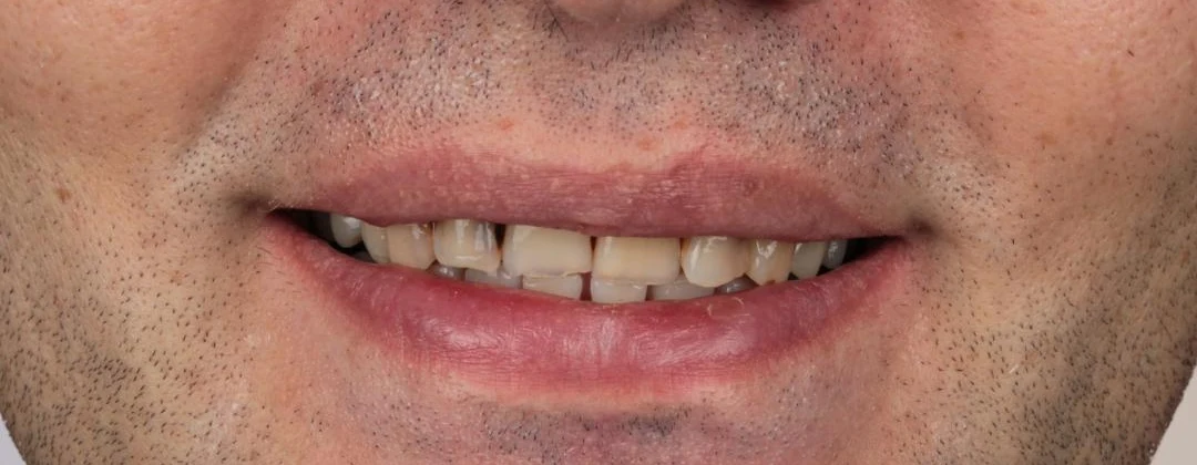Front teeth before E-max veneers, close-up smile