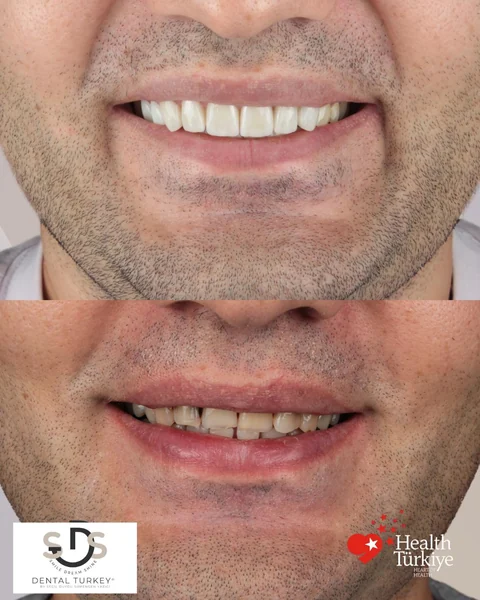 Vorher und nachher: E-max-Veneers an den Frontzähnen